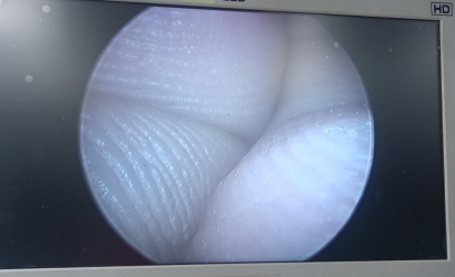 宮腔鏡的介紹及好克宮腔鏡 T3317的維修案例