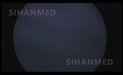 經(jīng)皮腎鏡聯(lián)合輸尿管軟鏡同期治療介紹及SOPRO經(jīng)皮腎鏡維修案例